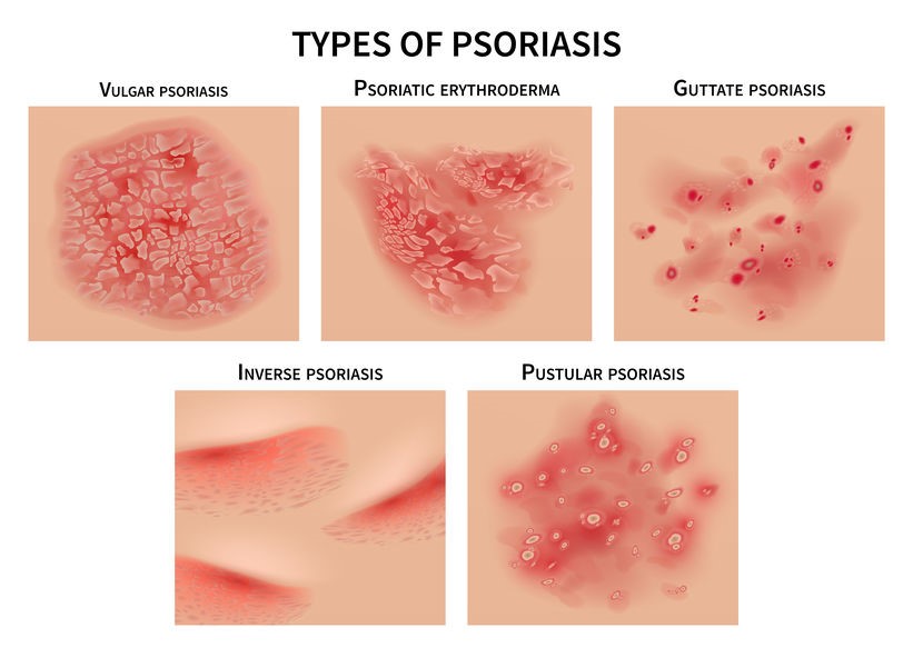 Plakk Psoriasis differenciáldiagnózis | Sanidex Magyarországon